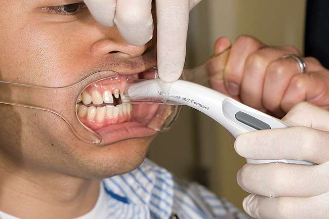 Digital Shade Determination of tooth shade by Electronic Guide