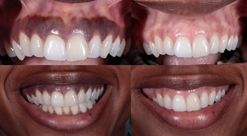 laser-gum-depigmentation-cost-gum-bleaching-delhi