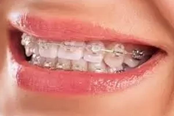 Which is Better: Metal Braces or Ceramic Braces