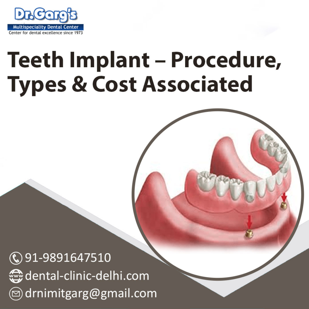 Teeth Implant- Procedure, Types and Cost Associated
