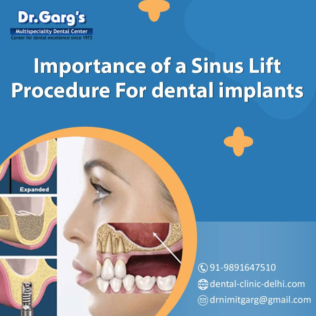 Sinus Lift Procedure For dental implants
