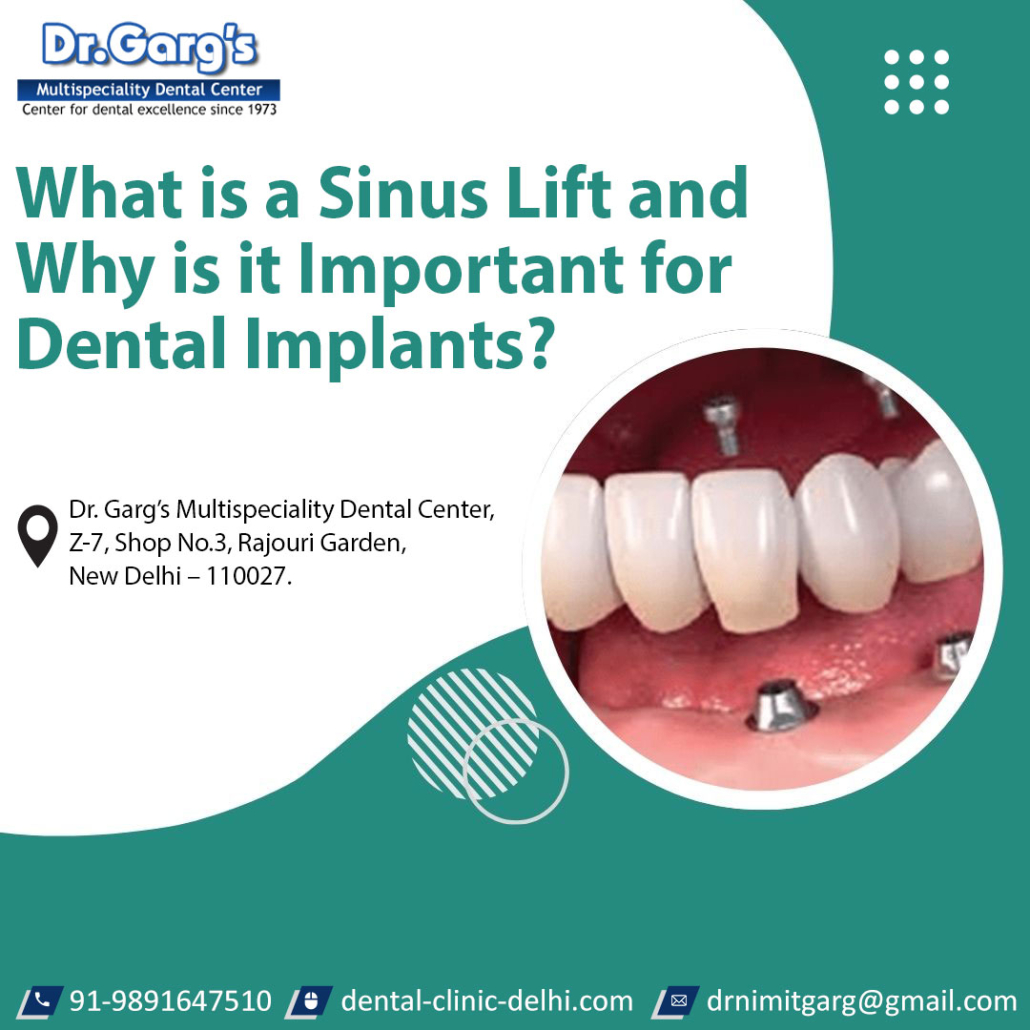 What is a Sinus Lift and Why is it Important for Dental Implants?