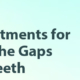 #ClosingTheGapsInTeeth
