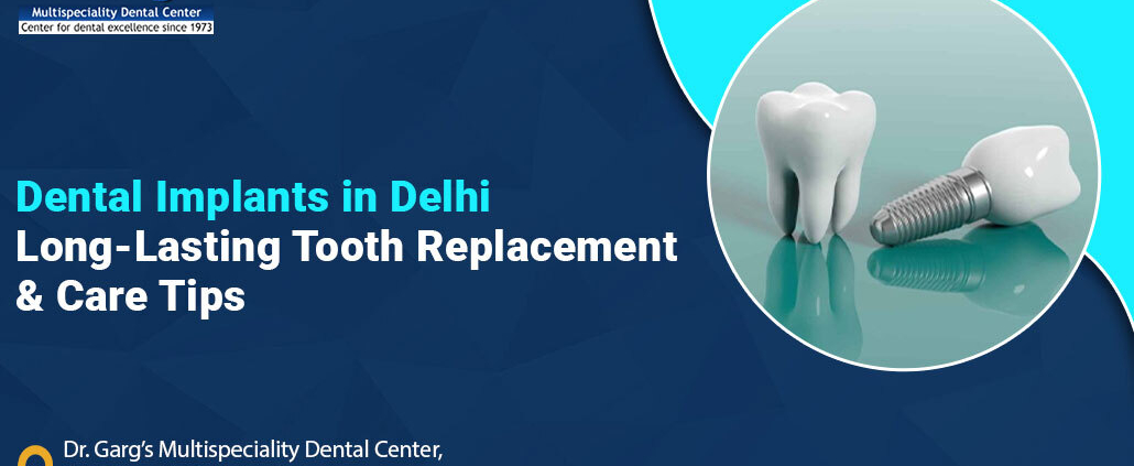 dental implants in delhi