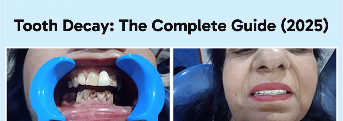 Tooth Decay The Complete Guide (2025)