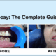 Tooth Decay The Complete Guide (2025)